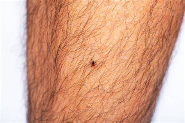 How to remove black legged tick?