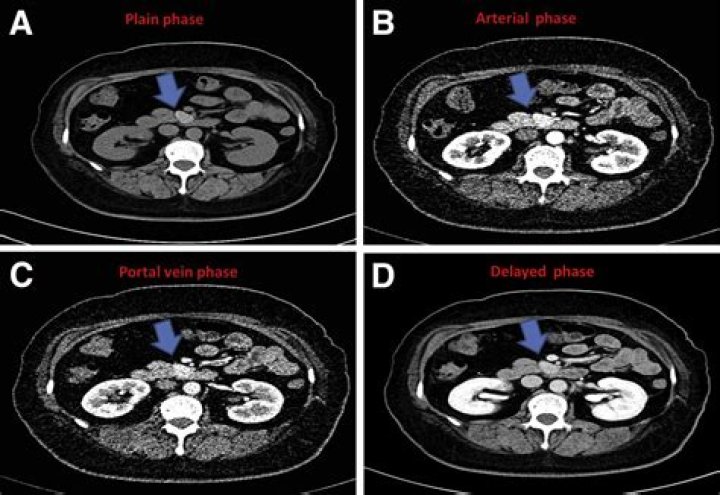Whats a hypervascular mass?