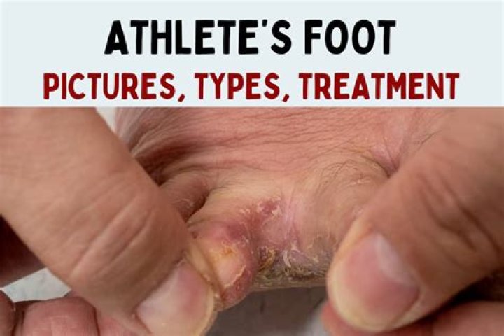 Where does athlete's foot come from?