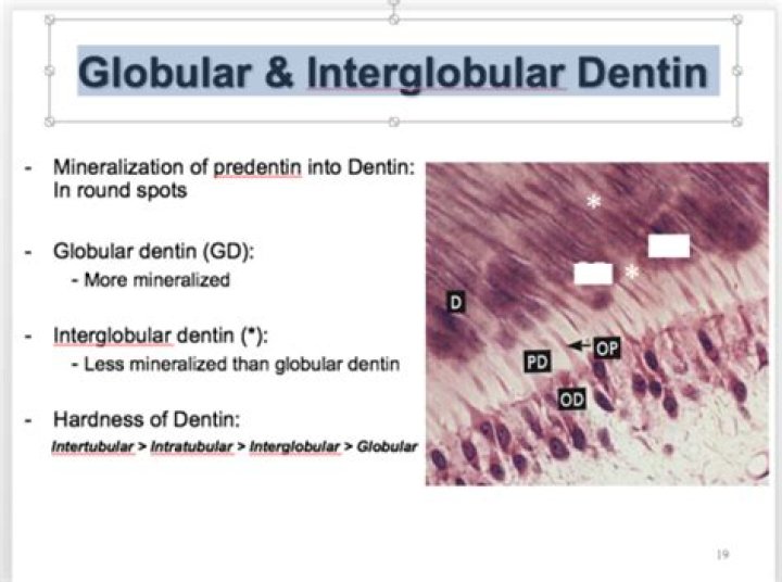 Where is interglobular dentin found?