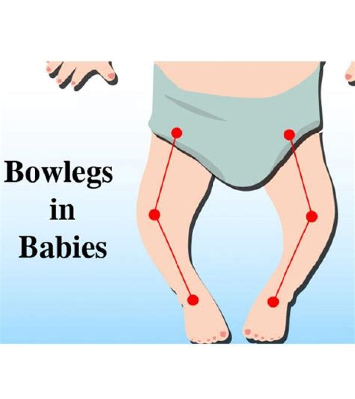 Why are black babies bow legged?