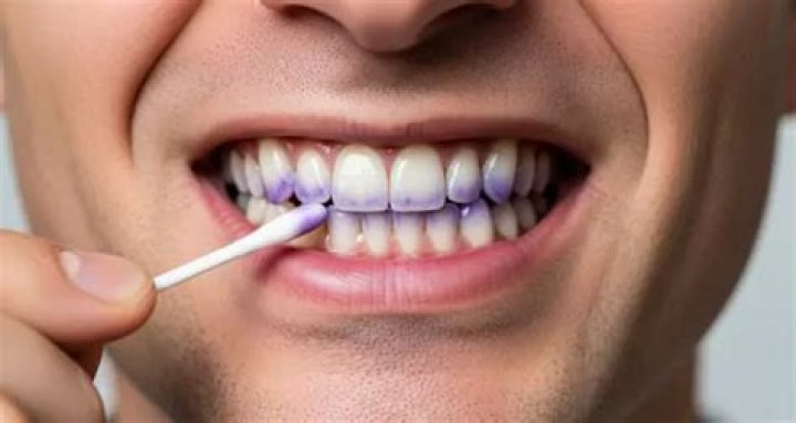 Will gentian violet stain teeth?